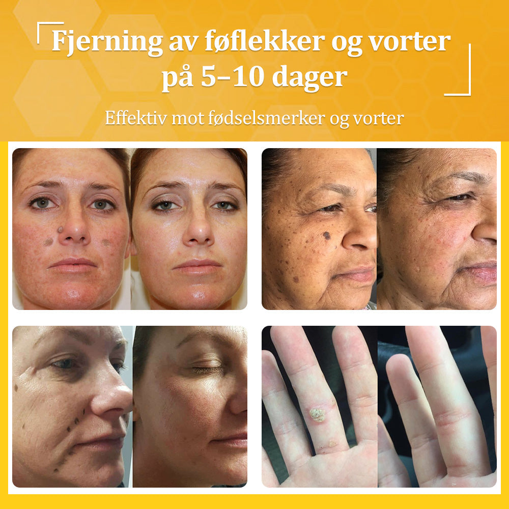 🐝LOVILDS® Strong Bee Venom Cream – Dermatologically tested and certified by dermatologists. Effective solution for stubborn warts, skin nodules, lesions, infections, and scars